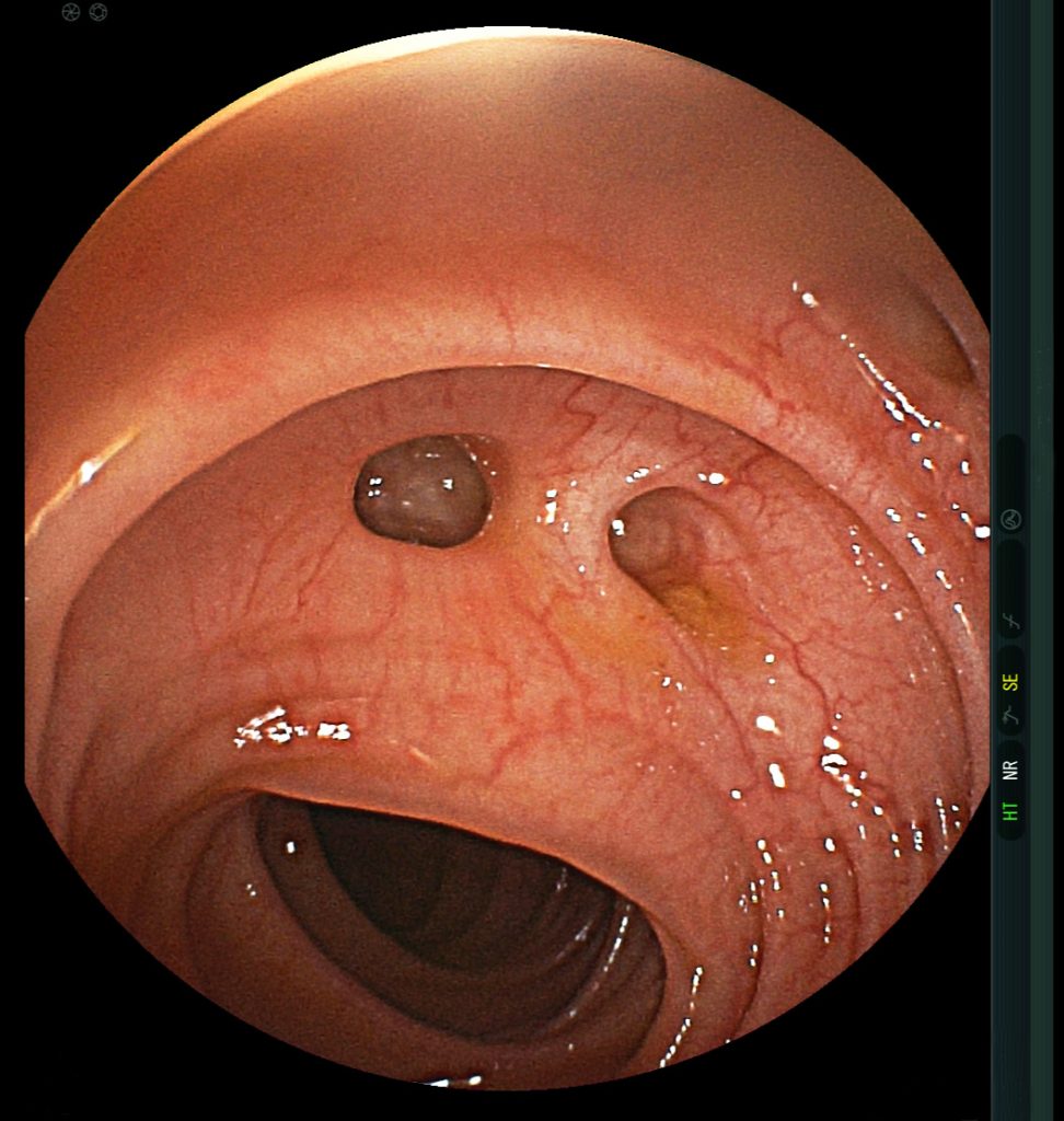 Kansas City Diverticular Disease Colon