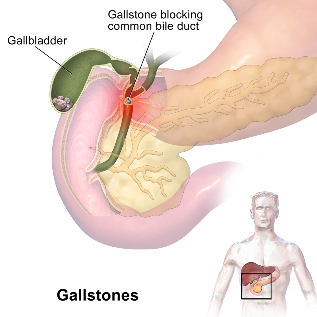Kansas City Gallstones Disease Colon
