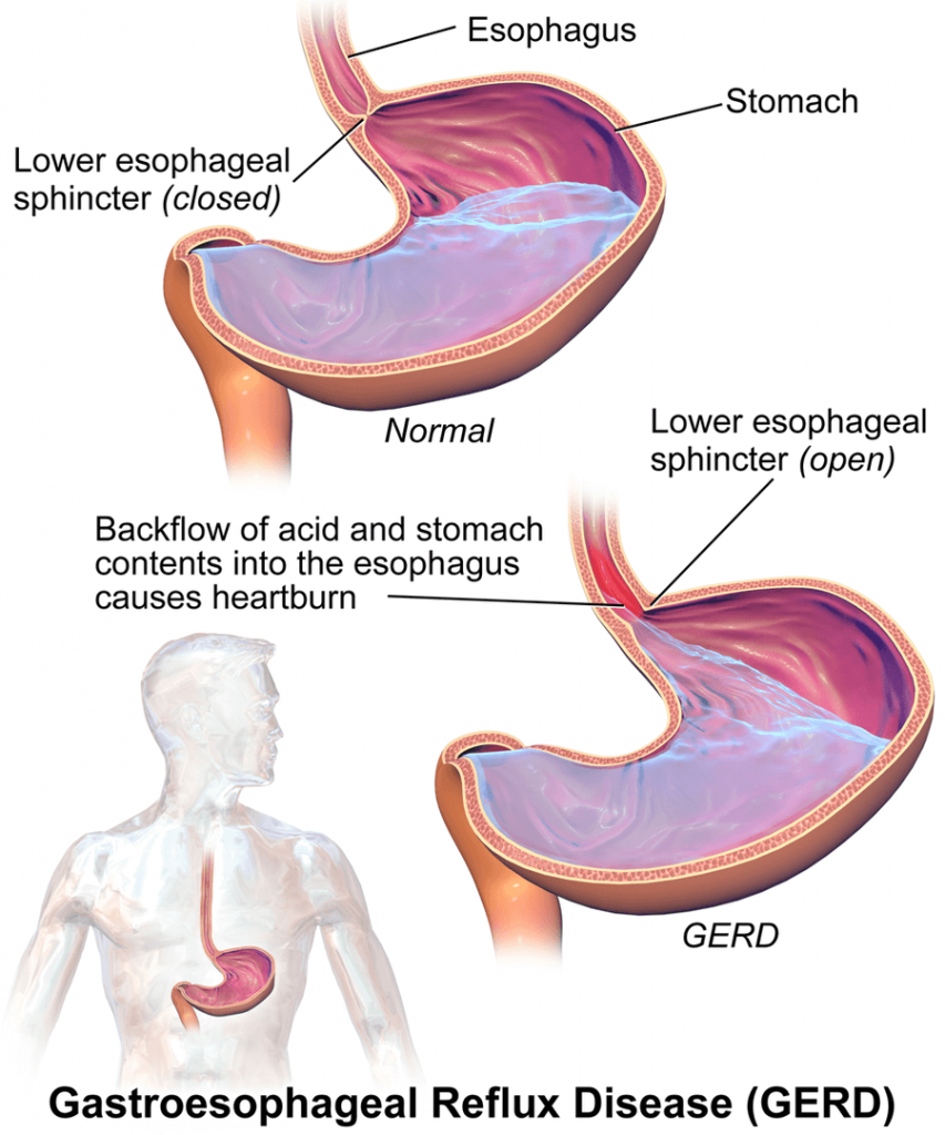 Kansas City Gastroesophageal Reflux Disease