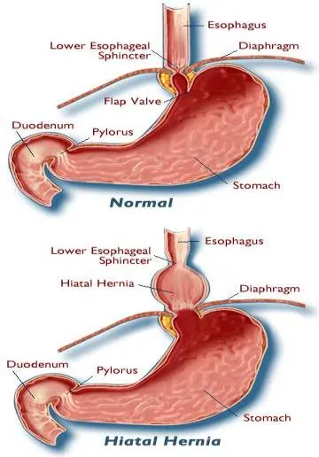 Kansas City Hiatal Hernia Disease Illustration Doctors